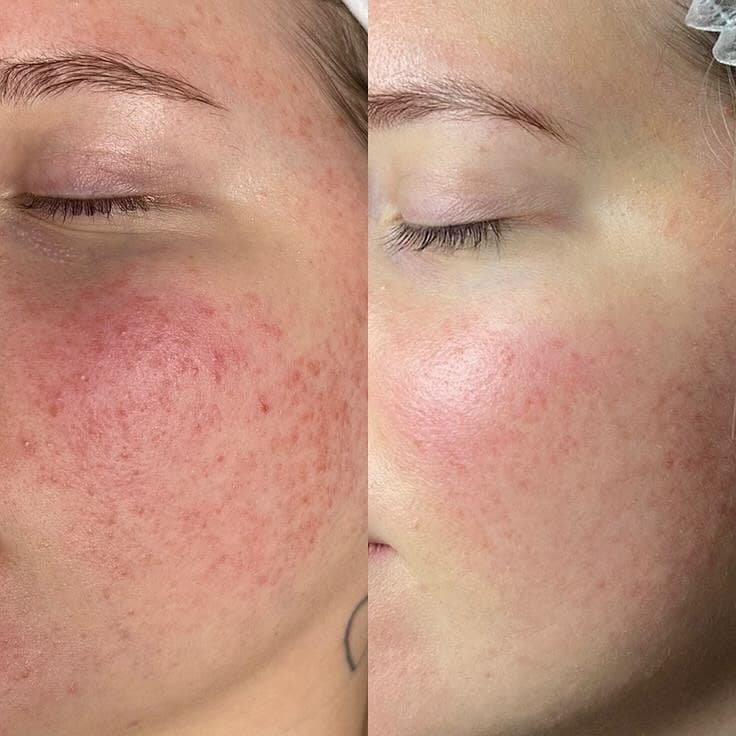 Close-up of a cheek, redness and bumps visibly reduced